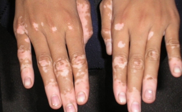 Társbetegségekkel járhat együtt a vitiligo